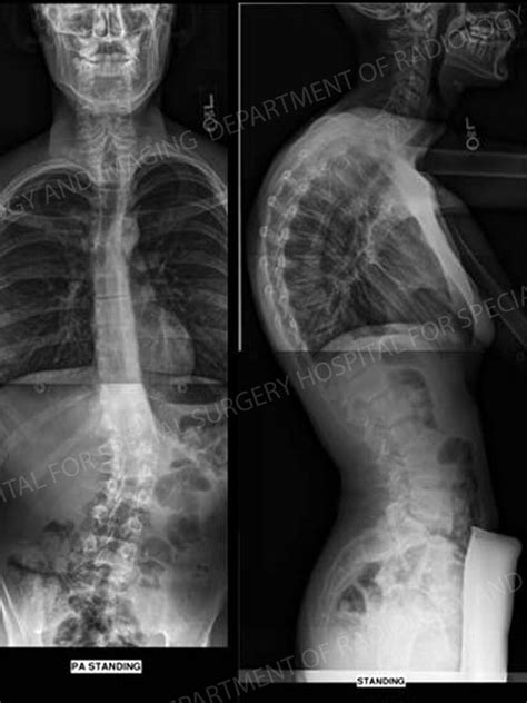 Kyphotic View .
